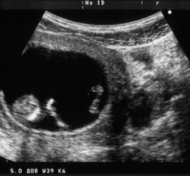 ultrasound to announce pregnancy
